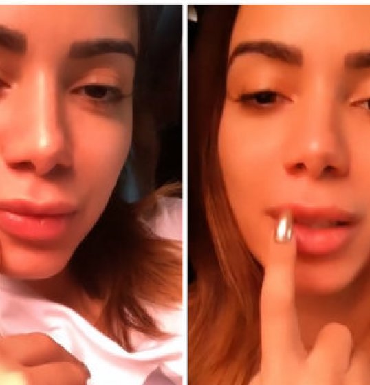Anitta faz preenchimento labial inspirado em filtro do Instagram